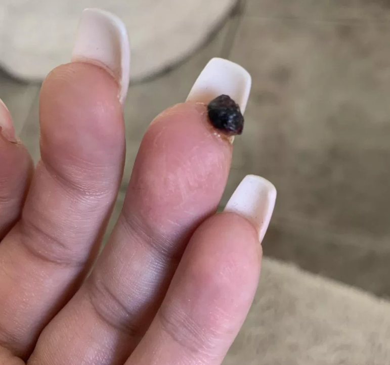 Девушка получила огромную «бородавку» вместо модных ногтей Маникюр в салоне завершился ампутацией пальца