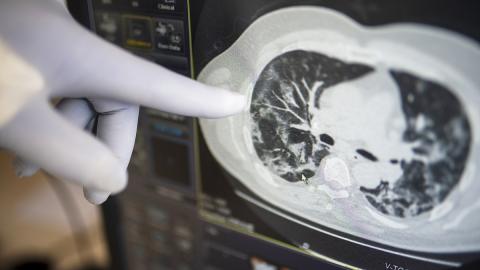 Раскрыт «отложенный эффект» коронавируса: может поражать органы после выздоровления коронавирус поражает органы