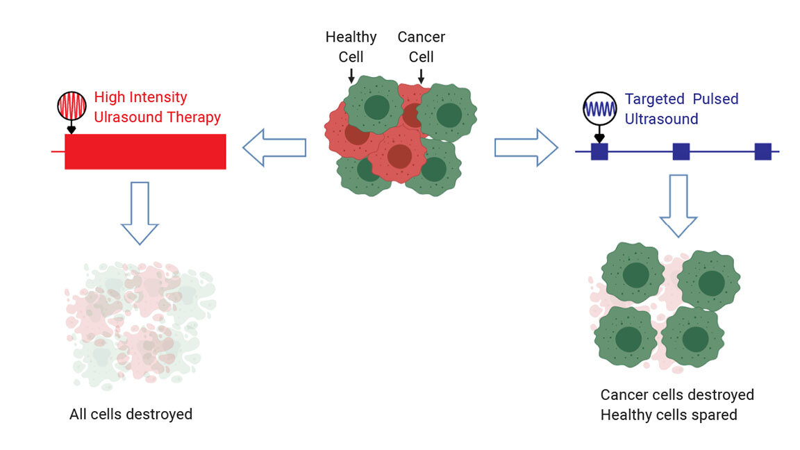 Особый вид ультразвука способен прицельно лечить рак Особый вид ультразвука способен прицельно лечить рак